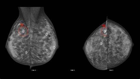 Diagnostic Accuracy of Digital Mammography in the Detection of .